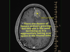 Eşi tarafından sosyal medyaya yüklenen Michael Prinke'nin MRI taraması