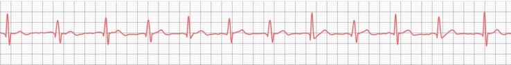 Ucuz akıllı saatler bile temel EKG'leri başarıyla kaydedebildiklerini göstermiştir